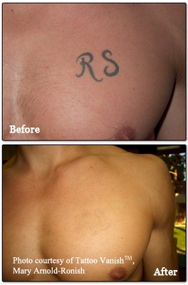 Certified Tattoos Guide to Tattoo Removal Denver  Certified Tattoo Studios